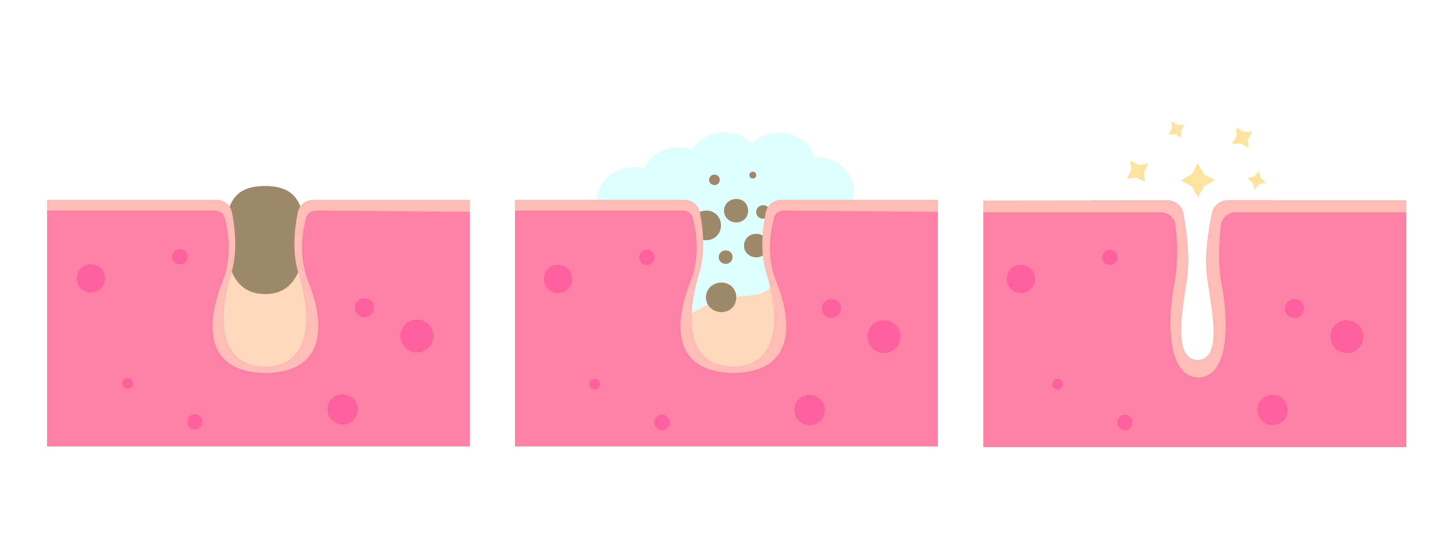 illustration on how cleansing removes sebum, dirt, and germs